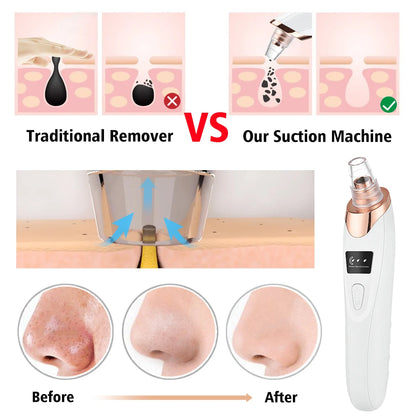 BLACKHEAD VACUUM PRO – Deep Pore Cleaner with 5 Suction Heads & Adjustable Suction Levels